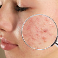 What is the most effective face treatment for acne?