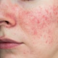 Can too much vitamin d cause skin rash?