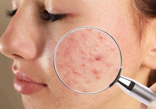 What is the most effective face treatment for acne?