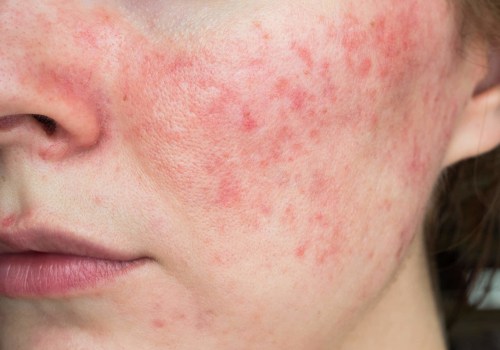 Can too much b12 cause skin rash?